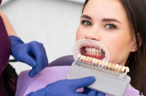 Composite Bonding: Achieving Effortless Elegance in Dental Artistry